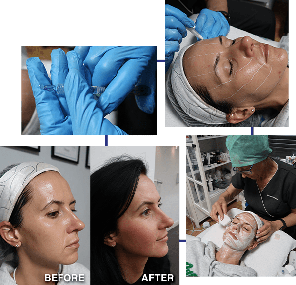 Mesotherapy Facial